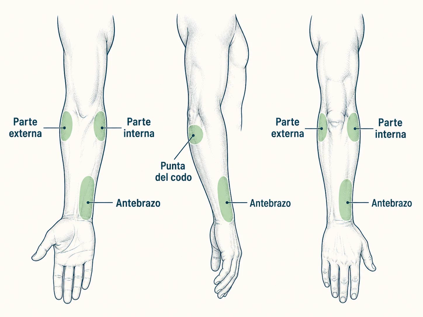 Zonas frecuentes del dolor de codo: parte externa, parte interna, punta del codo y antebrazo.